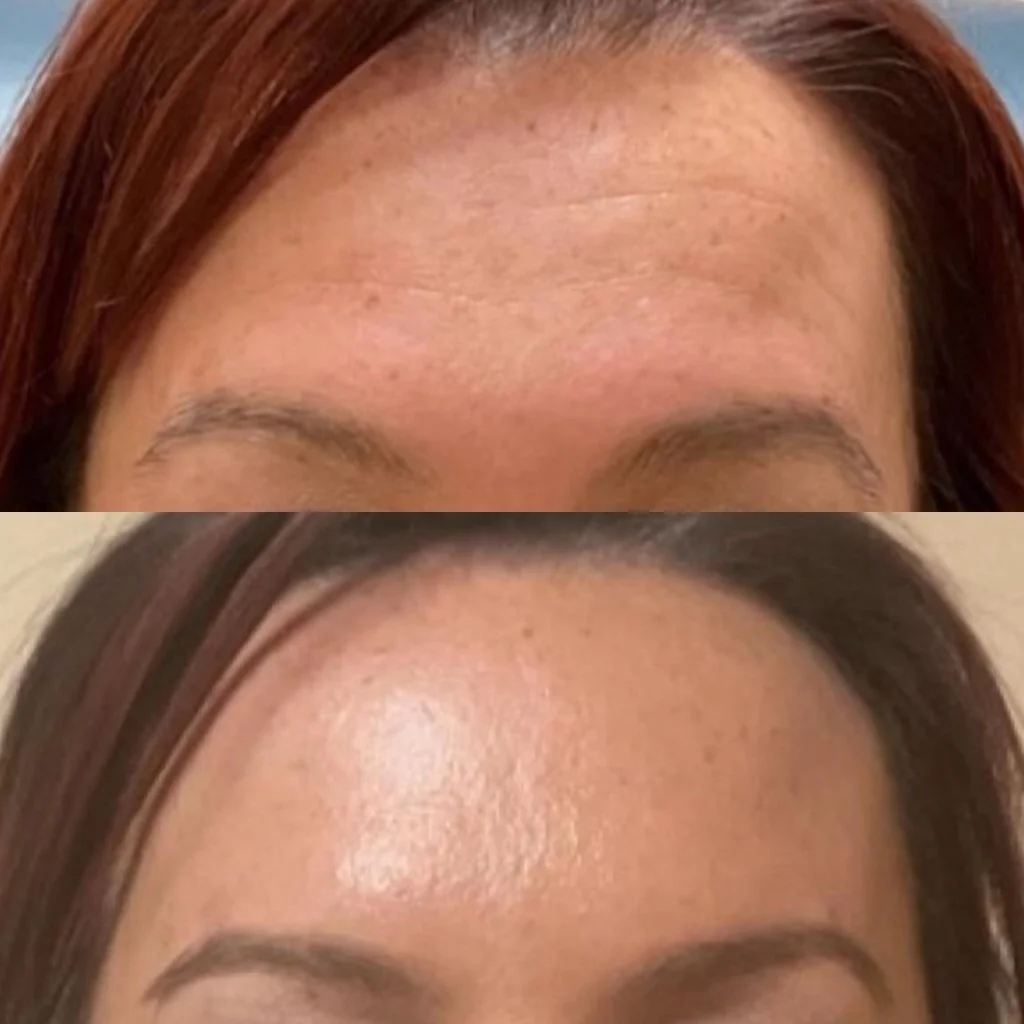 Before and after: horizontal forehead lines visibly softened