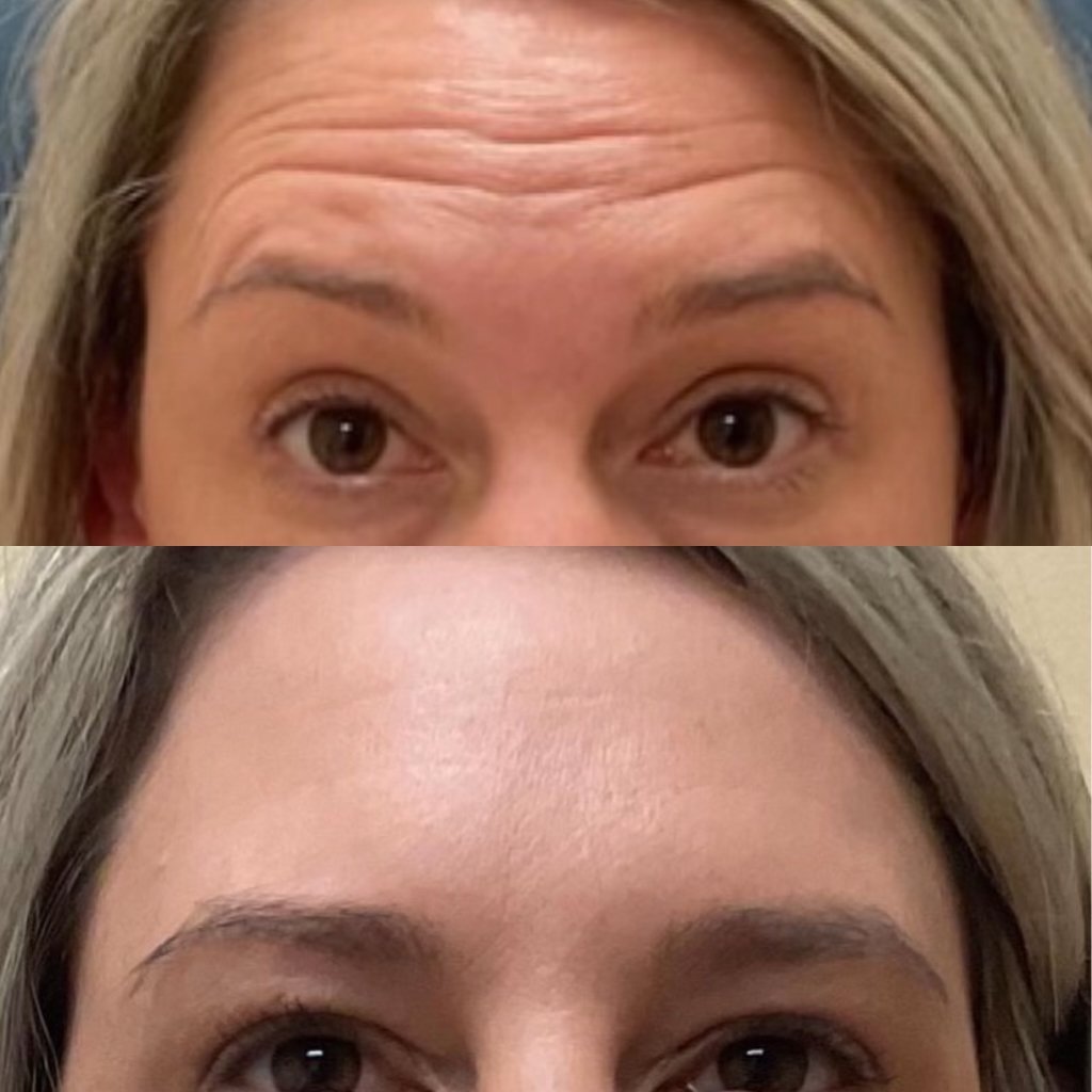 Before and after: deep forehead wrinkles smoothed
