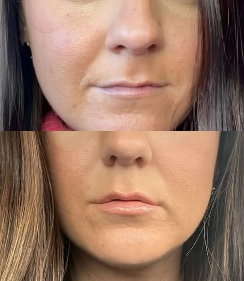 Before and after: fuller lips and softened lines around the mouth