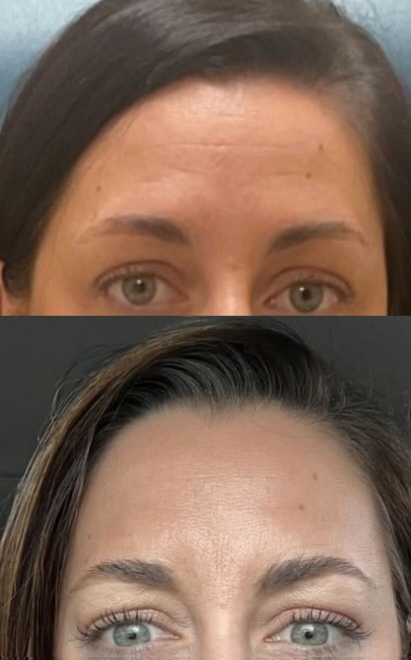 Before and after: smoother, more even forehead